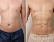 お腹の脂肪吸引から5年。再来院した男性モニターの今