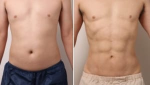 お腹の脂肪吸引から5年。再来院した男性モニターの今