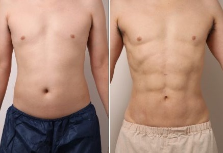 お腹の脂肪吸引から5年。再来院した男性モニターの今