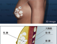 乳輪のふくらみが気になるという女性化乳房症例