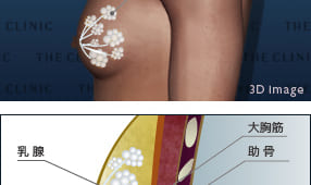 乳輪のふくらみが気になるという女性化乳房症例