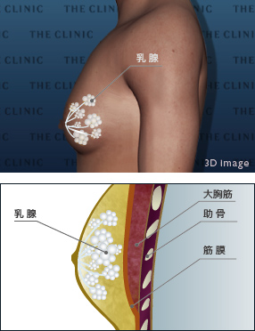 真性女性化乳房とは