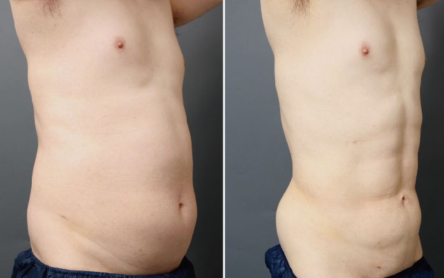 お腹の脂肪吸引の写真:横