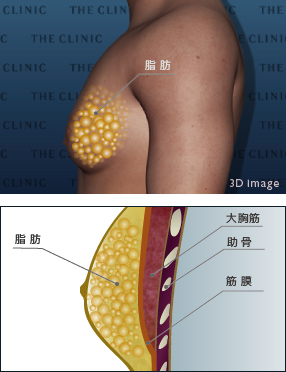 偽性女性化乳房とは