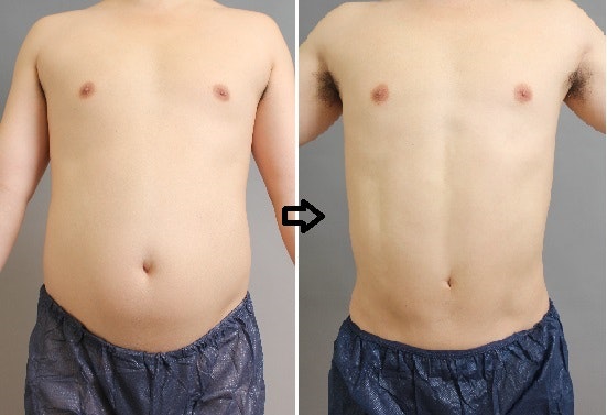 お腹の脂肪吸引の症例写真(男性/前)