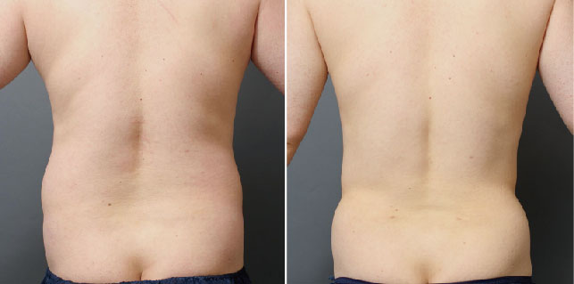 腰の脂肪吸引の症例写真