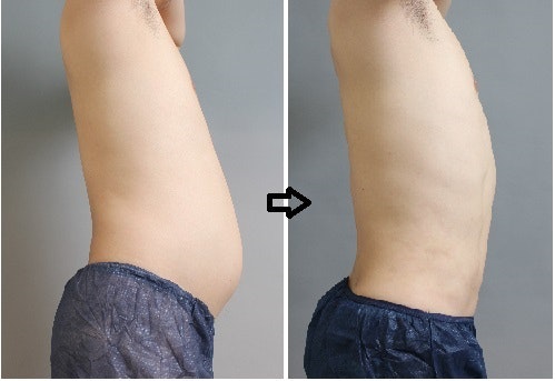 お腹の脂肪吸引の症例写真(男性/横)