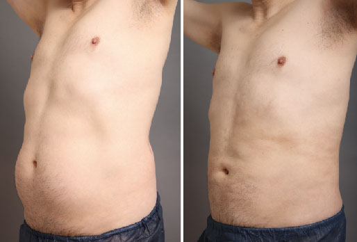 男性のお腹脂肪吸引の成果(斜め前)