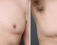 女性化乳房の治療で、皮膚の引き締め施術を併用した症例