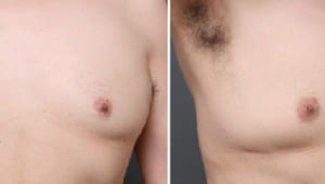 女性化乳房の治療で、皮膚の引き締め施術を併用した症例