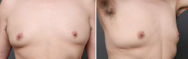 女性化乳房の治療で、皮膚の引き締め施術を併用した症例