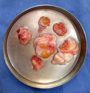 女性化乳房の治療にて摘出した乳腺