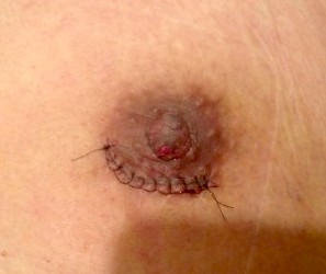 女性化乳房の治療によってできる傷