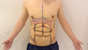 他院の脂肪吸引修正（術前マーキング）