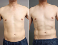 男性のために開発された、お腹の脂肪吸引施術の最高峰とは?