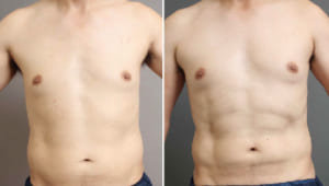 男性のために開発された、お腹の脂肪吸引施術の最高峰とは?