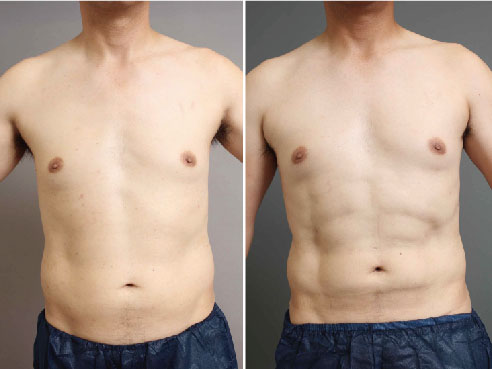 男性のために開発された、お腹の脂肪吸引施術の最高峰とは?