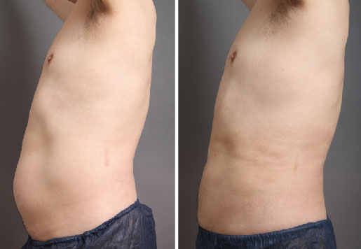 男性のお腹脂肪吸引の成果(横)