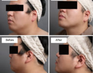 二重顎やたるみに、顔（頬・顎）脂肪吸引は効果あり?