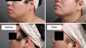 二重顎やたるみに、顔（頬・顎）脂肪吸引は効果あり?