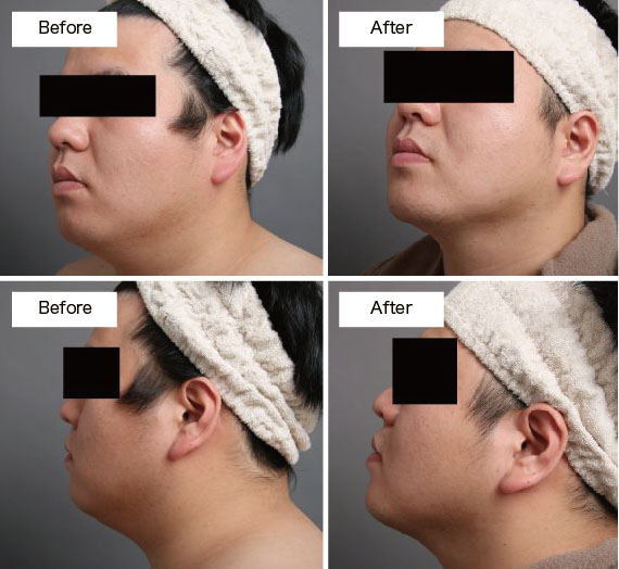 顔(頬・顎)の脂肪吸引を受けられた男性の症例写真