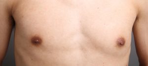 女性化乳房治療の症例(前)