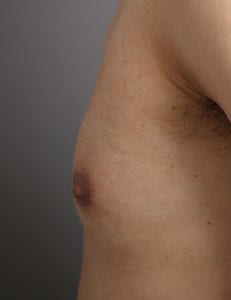 女性化乳房治療の症例(横)