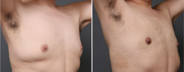 混合性女性化乳房の術前の写真