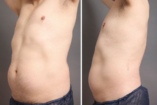 内臓脂肪が蓄積した男性(脂肪吸引前)