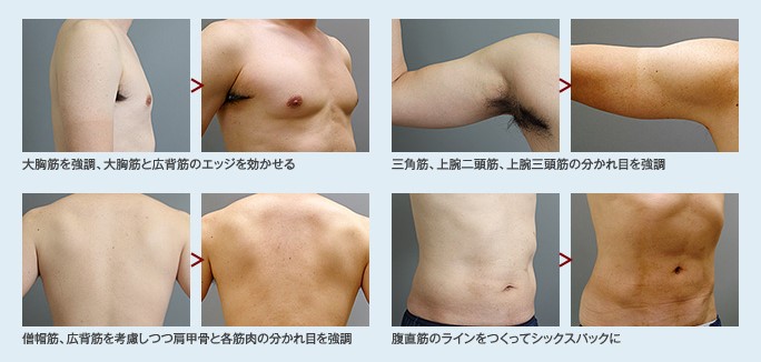 男性の脂肪吸引症例（胸、二の腕、お腹、背中）