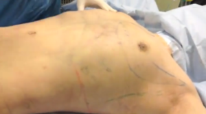 他院の脂肪吸引修正（手術直後）