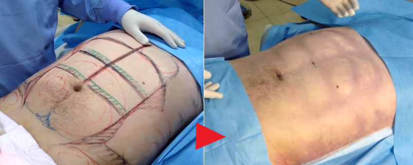 脂肪吸引によって男性のお腹に現れたシックスパック