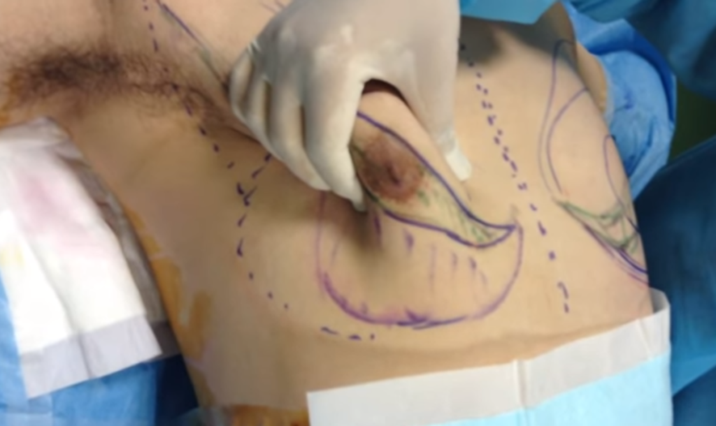 女性化乳房症例(術前)