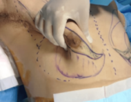 なかなか見られない、女性化乳房の手術手順を細かく紹介