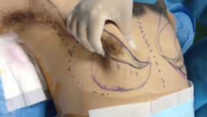 なかなか見られない、女性化乳房の手術手順を細かく紹介