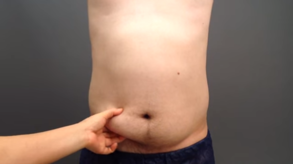 脂肪吸引で男性の腹部をシックスパックに改造! 気になる手術を公開