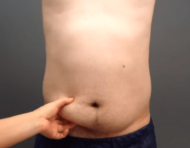 脂肪吸引で男性の腹部をシックスパックに改造! 気になる手術を公開