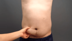 脂肪吸引で男性の腹部をシックスパックに改造! 気になる手術を公開