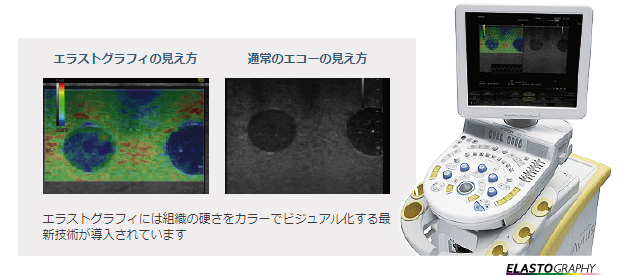女性化乳房の判定に活用する、乳腺専用エコー（エラストグラフィ）