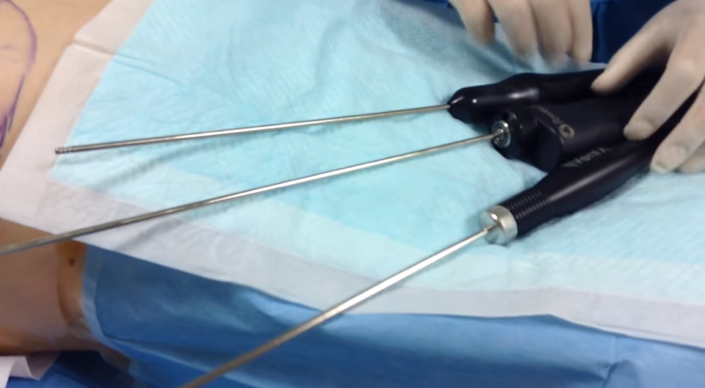 脂肪吸引で用いる各種機材