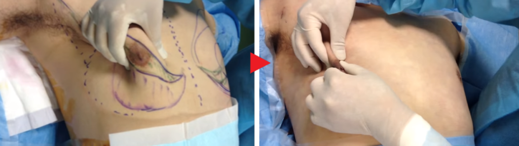 女性化乳房の手術前後の比較