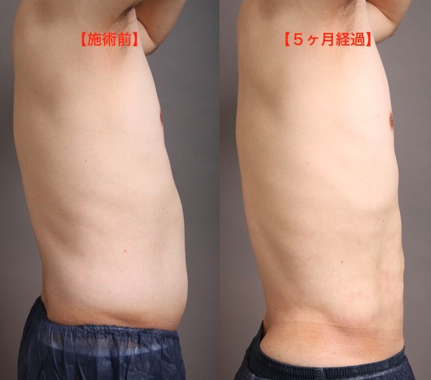 男性の脂肪吸引の術前後比較(横)