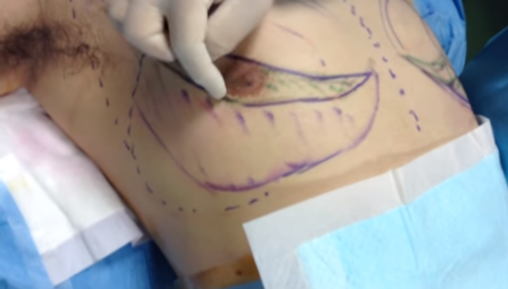 女性化乳房手術の傷跡