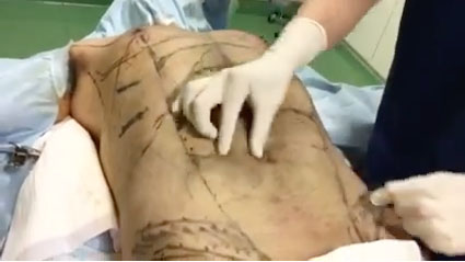 脂肪吸引直後の男性のお腹