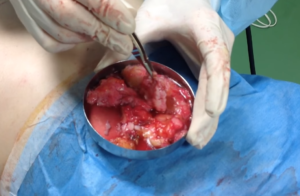 真性女性化乳房から摘出した乳腺