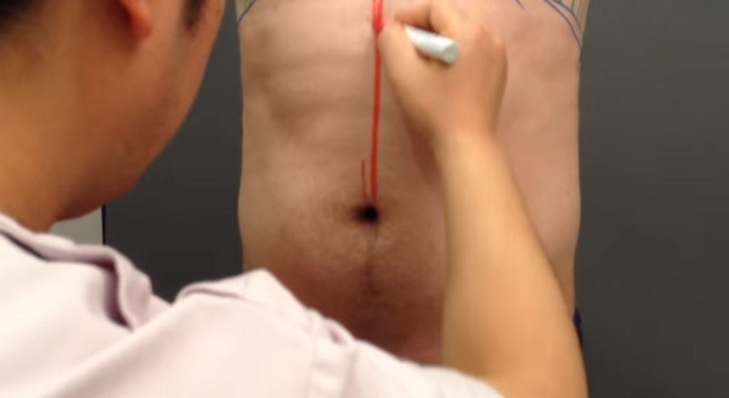 男性のお腹の脂肪吸引前も行うマーキング