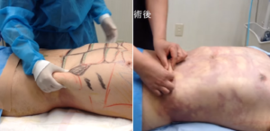 脂肪吸引前後（男性／腹部）