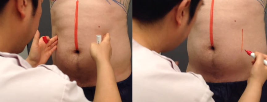 男性の脂肪吸引ゲストに行った腹直筋のマーキング
