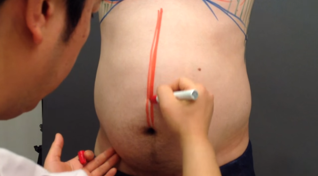 男性のお腹の脂肪吸引前に行ったマーキング