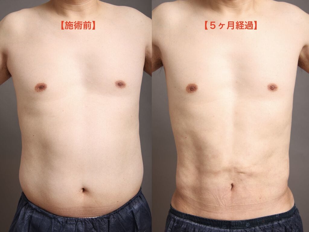 男性の脂肪吸引の術前後比較
